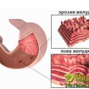 Recunoaștere și metode pentru tratamentul ulcerului gastric în timp util