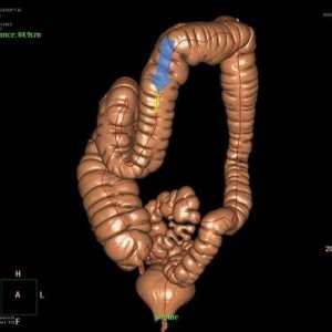 Sunt rezultatele exacte ofera intestinului colonoscopie virtuala?