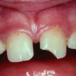 Traumatisme dentare