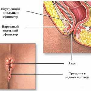 Fisura in anus