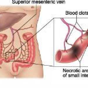 Tromboza vaselor mezenterice ale intestinului
