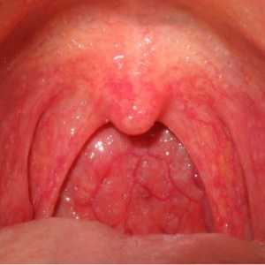 Copilul a laringelui și a gâtului umflarea