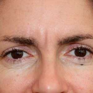 Injecțiile cu Botox anti-rid între sprâncene