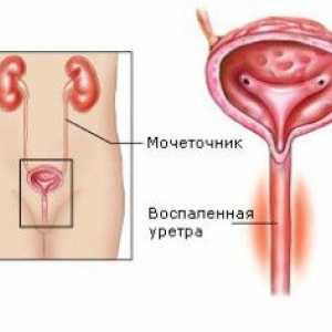 Uretrita la femei, un tratament popular. Simptomele bolii.