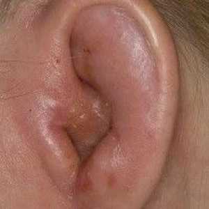 Urechi și picături pentru ochi „Sofradeks“: instrucțiuni de utilizare