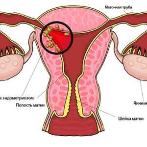 Sfaturi ginecologul: atunci când face cu ultrasunete pentru endometrioza