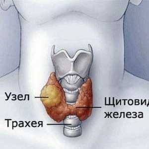 Gusa nodulara a glandei tiroide