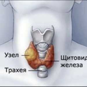 Nodurile asupra glandei tiroide extinse - Simptome, Diagnostic si Tratament