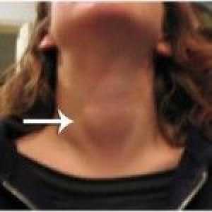 Nodurile din glanda tiroidă: principalele simptome, efecte adverse