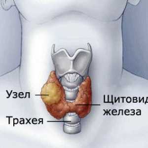Nodurile din glanda tiroidă
