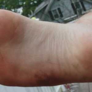 Care este riscul de phlegmon piciorului