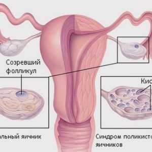 O problemă importantă pentru multe femei: cum de a vindeca sindromul ovarului polichistic?
