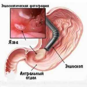 Tipuri, simptome si tratamentul gastritei catarale