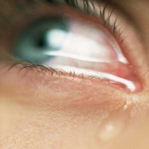 Inflamarea ochilor, pleoapelor (blefarita), lăcrimare. Tratamentul de remedii populare.