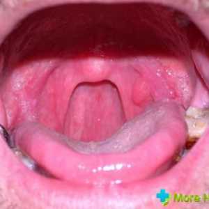 Inflamarea limbii în gât: tratamentul este metodele conservatoare și tradiționale