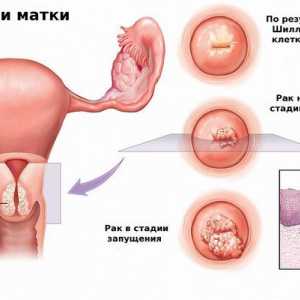 Inflamarea colului uterin sau tservitit