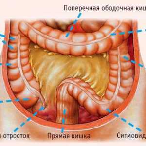 Inflamația colonului sigmoid