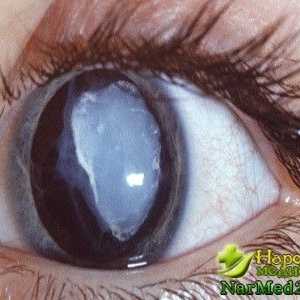 Toate metodele de populare și tratament clasic al cataractei