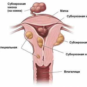 Întotdeauna există o intervenție chirurgicală pentru fibrom uterin?