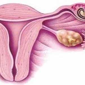 Identificarea etapele timpurii ale sarcinii ectopice: simptome si diagnostic.