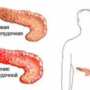 Identificarea cauzelor de pancreatita