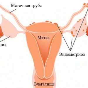 De ce este atribuit la terapie fizică pentru endometrioza