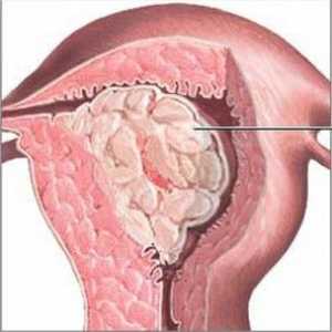 Glandulara hiperplazie endometriala: cauze, forme și etape de tratament
