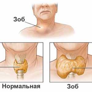 Gusa a glandei tiroide la om: principalele simptome și semne ale bolii la femei, cum să trateze…